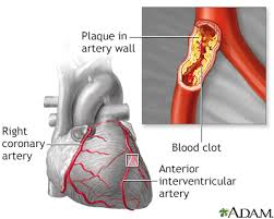 As a strong antioxidant, ginger works to break down bad cholesterol.ginger is used in natural remedies for nausea and headaches, and multiple studies indicate that it may also bring down levels of fatty cholesterol in the body. Hardening Of The Arteries Information Mount Sinai New York