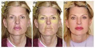 Facial Fat Grafting: Why, Where, How, and How Much?