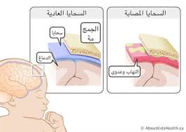 التهاب السحايا
