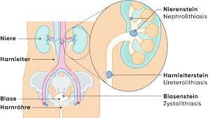 Image result for Nephrolithiasis