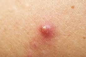 Komischer pickel schamlippe anti pickel patches ?? Abszess Das Hilft Gegen Eitrige Pickel Beulen Gesundheit De