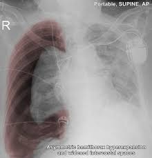 Image result for Pneumothorax