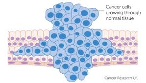 Cancer, group of more than 100 distinct diseases characterized by the uncontrolled growth of abnormal cells in the body. What Is Cancer Cancer Research Uk