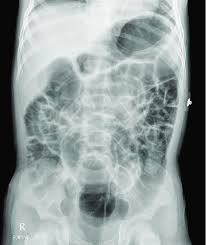 Image result for Adynamic Ileus