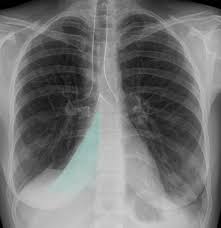 Image result for Atelectasis