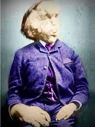Maybe you would like to learn more about one of these? Proteus Syndrome The Elephant Man And Beyond Cbs News