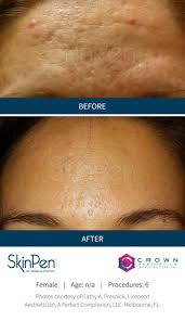 Find related and similar companies . Skinpen Microneedling Bb Aesthetic Medical Spa