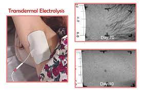 V2r home or professional electrolysis system for permanent hair removal with variety pack. Review Of Best Home Electrolysis Machine My Beard Gang