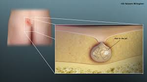 Image result for Pilonidal Cyst