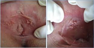 Benign “Lumps And Bumps” Of The Vulva