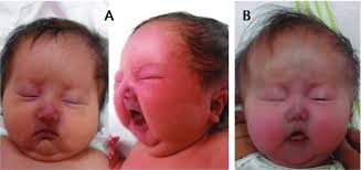 Patient 1 shows a small head, a prominent forehead, sparse hair,...