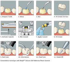 Find updated content daily for dental zirconia crown. Cementation Procedure For Lava Crowns And Bridges