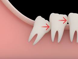If complications arise, it may take even longer to properly heal from a wisdom tooth extraction. The 48 Hours After Your Wisdom Teeth Have Been Removed Ironhorse Family Cosmetic Dentistry Leawood Kansas