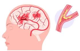 Transient ischaemic attack (TIA): what is a mini stroke? - BHF
