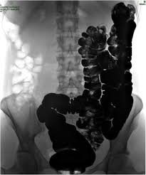 Image result for Midgut Volvulus