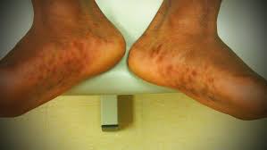 Image result for brown patches on the feet