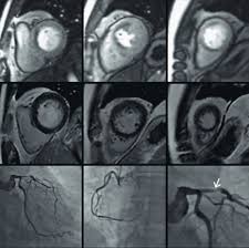 Image result for Cardiac MRI