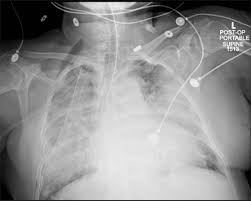 Image result for Transfusion Associated Circulatory Overload