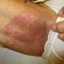 Soak a soft cloth in this solution and apply to the rash twice daily for up to 10 minutes. Intertrigo Symptoms Causes And Treatment