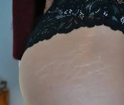 Stretch Marks Occur Mainly In Areas Sensitive To Variations Of Weight Ie The Abdomen Hips Breasts And The Upp Medical Problems Stretch Marks Skin Elasticity