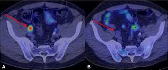 Breast cancer is the second most common cancer found in women — after skin cancer — but that doesn't mean men aren't at risk as well. Prostate Cancer Specific Pet Radiotracers A Review On The Clinical Utility In Recurrent Disease Practical Radiation Oncology