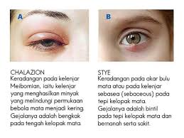 Nantinya, kamu bisa menghilangkan aneka iklan yang ada di hp mu, mau itu samsung, xiaomi, hp vivo, oppo, hingga. Sarawak Aritok Jenis Jenis Ketumbit Tembel Ketumbit Facebook