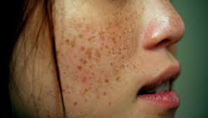 Image result for Freckled skin