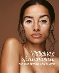 Ecco l'annuncio ufficiale! Grazie di cuore Matteo Bordignon Bella Aurora  Bella Aurora International Bella Aurora Italia🤍🤍 #adivit #associazione  #vitiligine #ricerca