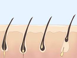 Sugaring is an ancient technique of hair removal, which has now regained popularity. 5 Ways To Get Rid Of Body Hair Wikihow