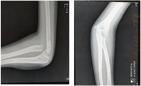 Image result for Radial Head Dislocation