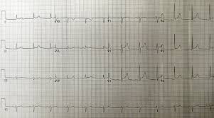 Pericardial effusion is a collection of fluid in the pericardial sac. Pericarditis Definition Und Synonyme Von Pericarditis Im Worterbuch Englisch