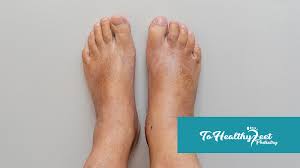 Image result for diabetic toes