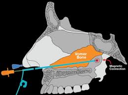 AMT Bridle™ Family | Nasal Tube Retaining Systems, Nasal Bridle