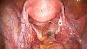 Laparoscopic surgery is a safe and effective option for many patients, provided the surgeon knows the relevant anatomic landmarks and variations created by obesity, prior surgery, and aberrant anatomy. Chapter 1 Normal Female Anatomy Melaka Fertility