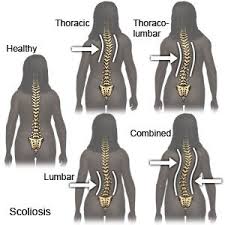 How to know if you have scoliosis scoliosis is a problem that triggers the curvature or switching of the back sidewards. Scoliosis In Children What You Need To Know