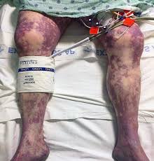 The evolution, morphology (purpura), distribution (acral) and infective prodrome of the patient's rash make viral ppgss the most likely diagnosis, despite this being rare. Purpura Fulminans