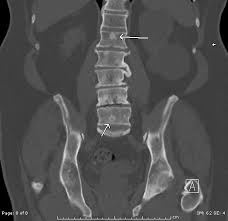 Mixed sclerotic lesions, including right sixth rib head as suggested on cxr, left lateral eighth rib and sternal sclerosis. Webpathology Com A Collection Of Surgical Pathology Images
