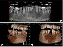 Osteosarcoma is a bone tumor and can occur in any bone, usually in the extremities of long bones near metaphyseal growth plates. Rare Case Of Mandibular Osteosarcoma Clinical Imaging And Pathological Aspects