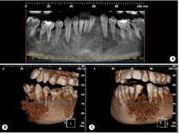 Cancer in bone can cause intermittent or progressively severe localized bone pain where the cancer is in the bone. Rare Case Of Mandibular Osteosarcoma Clinical Imaging And Pathological Aspects