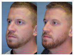 You can below few jawline exercise tools from below. Chin Implant Raleigh Nc Dr William Stoeckel Dr Adam Purzycki Wake Plastic Surgery And Med Spa