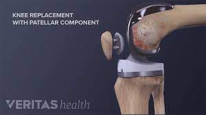The Pros and Cons of Minimally Invasive Knee Replacement Surgery |  Arthritis-health