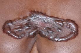 Most people get these scars after they injure their skin, such as from a cut or puncture wound. Keloids And Hypertophic Scars Keloid And Hypertrophic Scars Dermatology Advisor