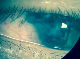 Suture Protruding From Lateral Sclera Photo By Jim Thompson Thompsons Photo Natural Landmarks