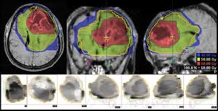 Https Neurologie Uni Bonn De Dateien Bilder Vorlesung Vorlesungneuroonkologie Pdf