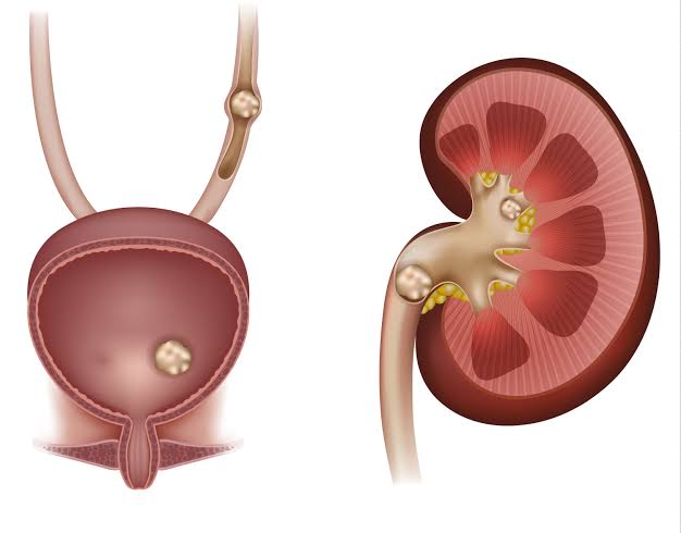home-remedies-for-kidney-stone-treatment-at-home