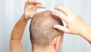 During the growth phase, hair follicle stem cells become activated to regenerate the follicle and hair, and hairs grow longer each day. Do You Have Folliculitis Hair Loss Modena Hair Institute