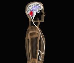 Pin On Iih Psuedotumor Cerebri Chiari