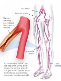 Difference Between Pad And Pvd Difference Between