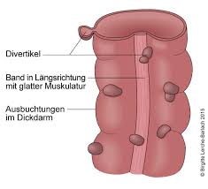 Die frage, ob und wann patienten mit divertikulitis operiert werden sollten, wurde und wird viel diskutiert. Divertikelkrankheit Deximed