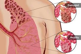 Slideshow Reasons You Re Short Of Breath Shortness Of Breath Causes Respiratory Health Shortness Of Breath